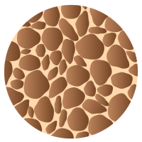 Severe Osteoporosis