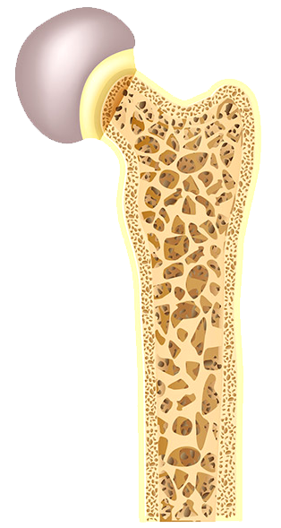 Osteopenia