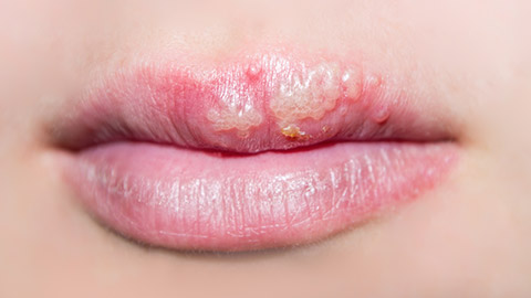 cold sore