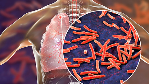 An illustration of tuberculosis