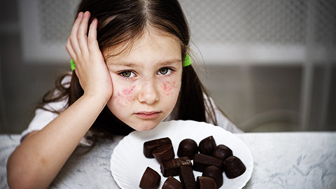 A child with chocolate allergic reactions