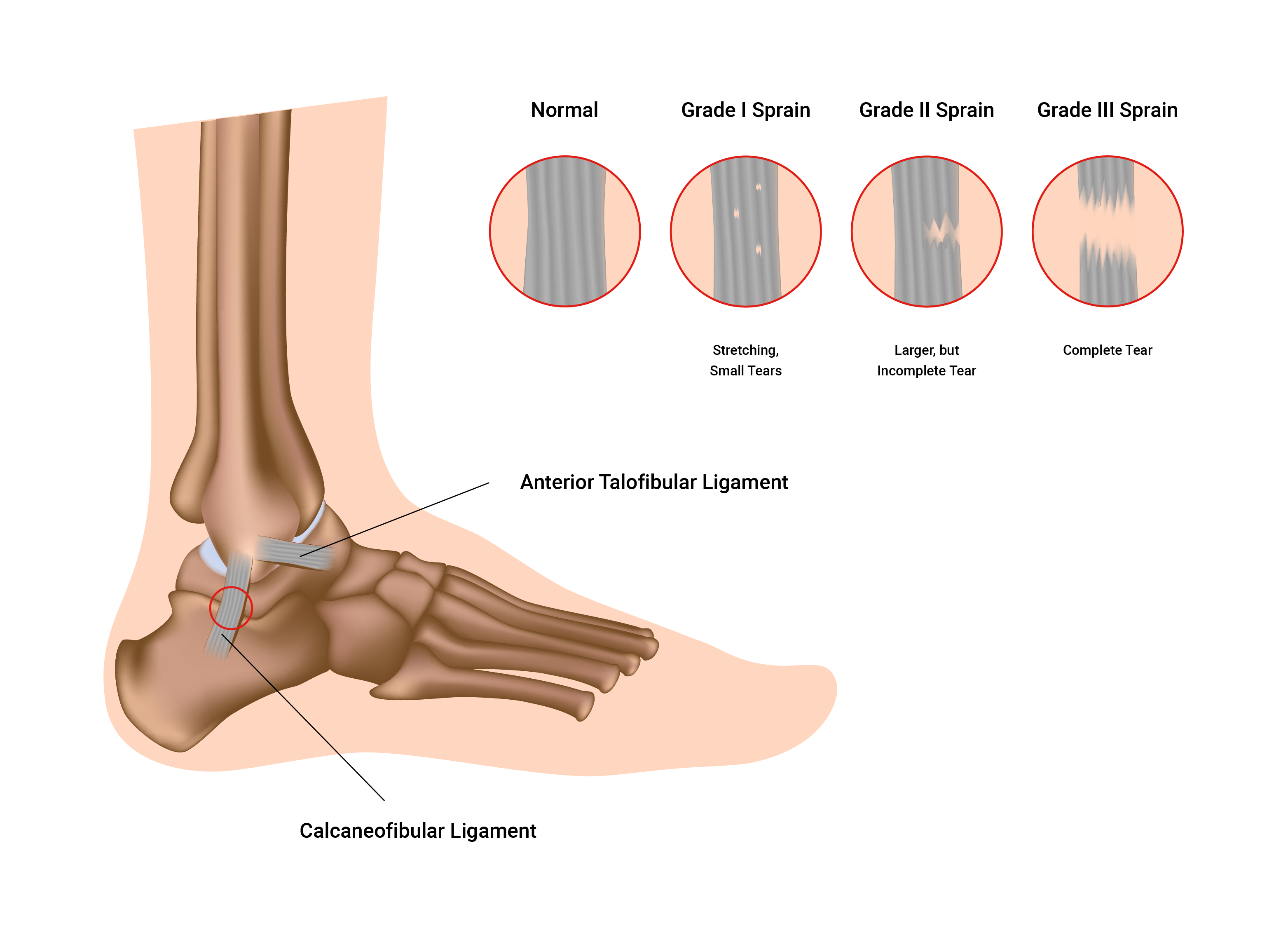 diagram of ankle sprain various levels