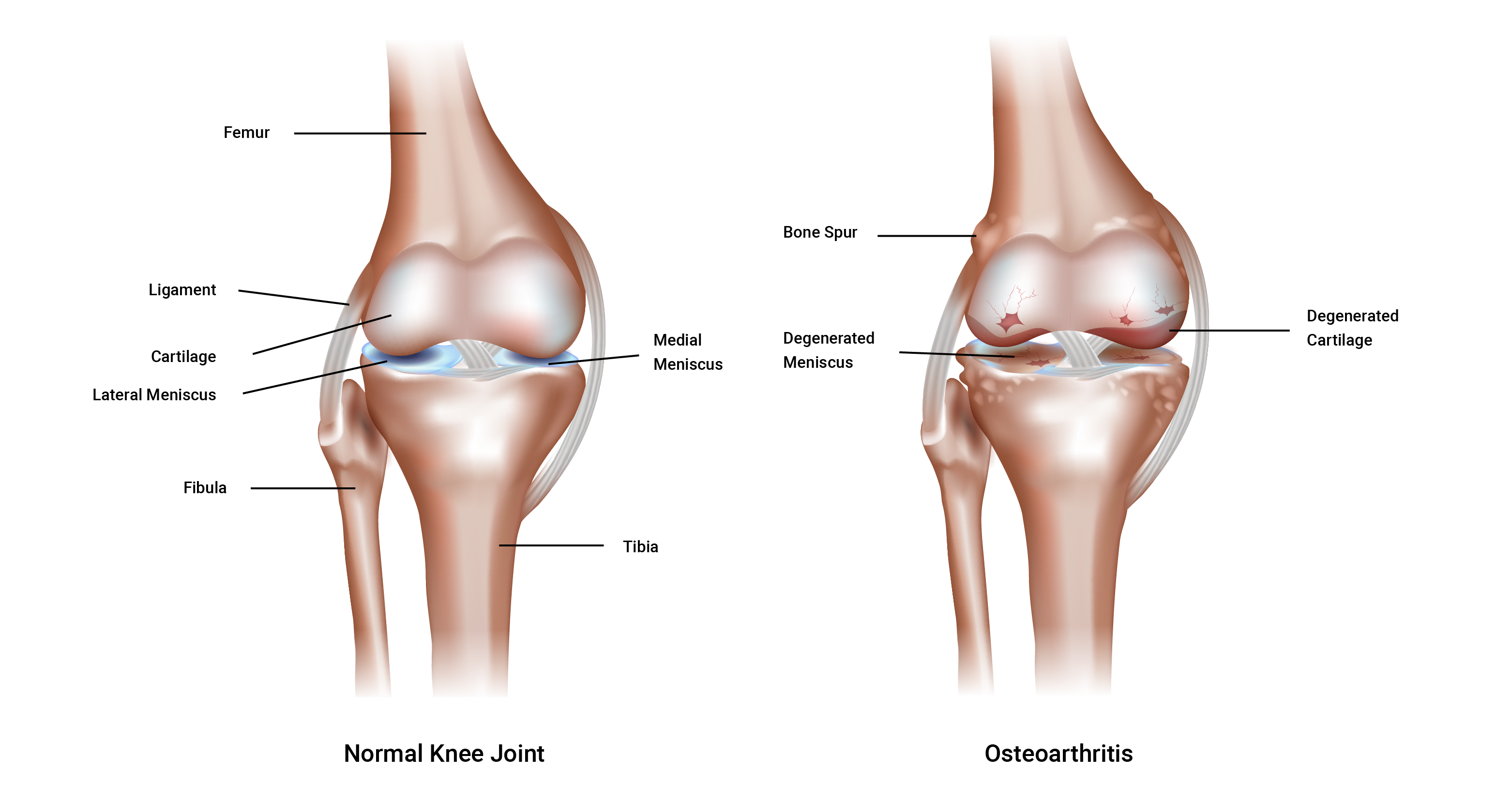 comparison diagram of normal and osteoarthritis knee