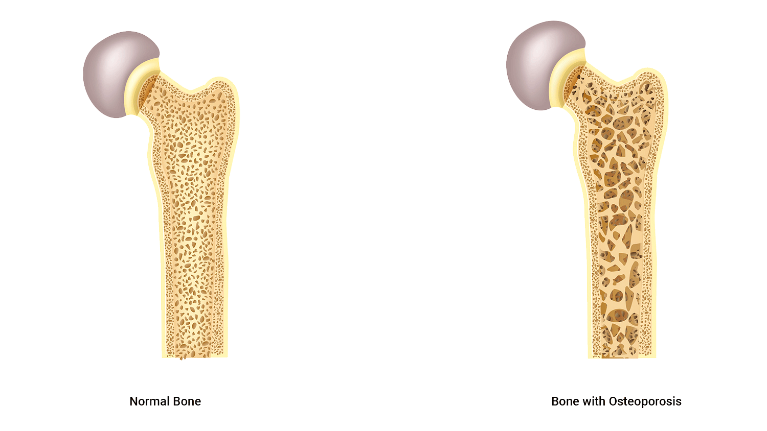 illustration of bones healthy and osteoporosis