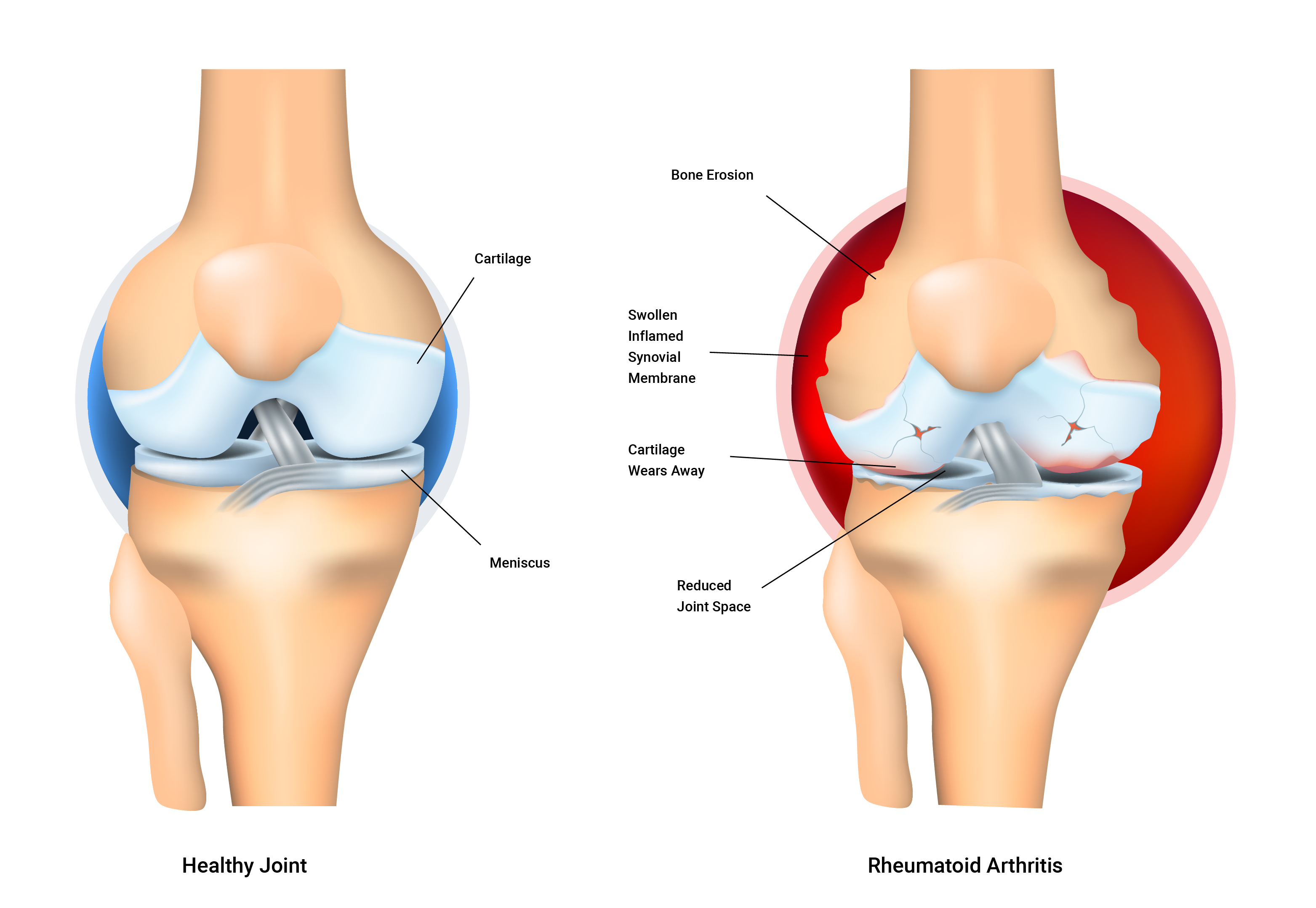 normal joint versus joint with rheumatoid arthritis
