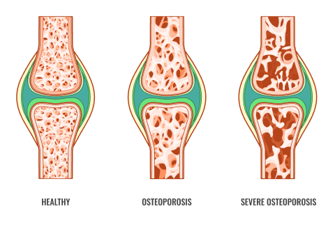 Stages of osteoporosis
