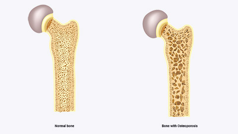 osteoporosis