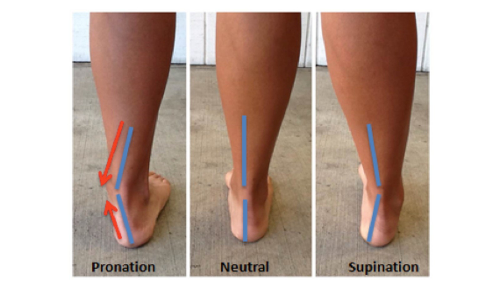 Photo showing Pronation, Neutral, and Supination ankle alignment