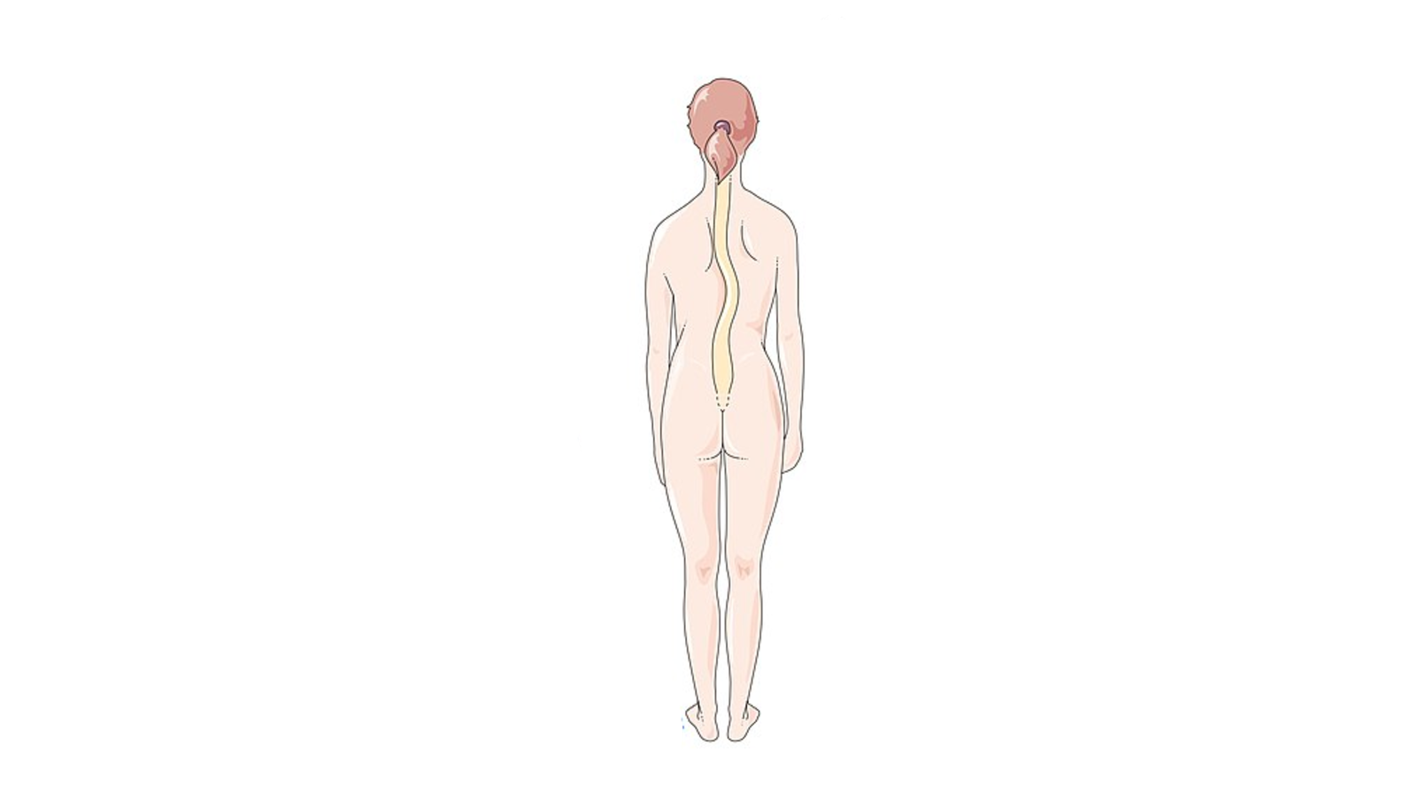 Diagram of person with Scoliosis